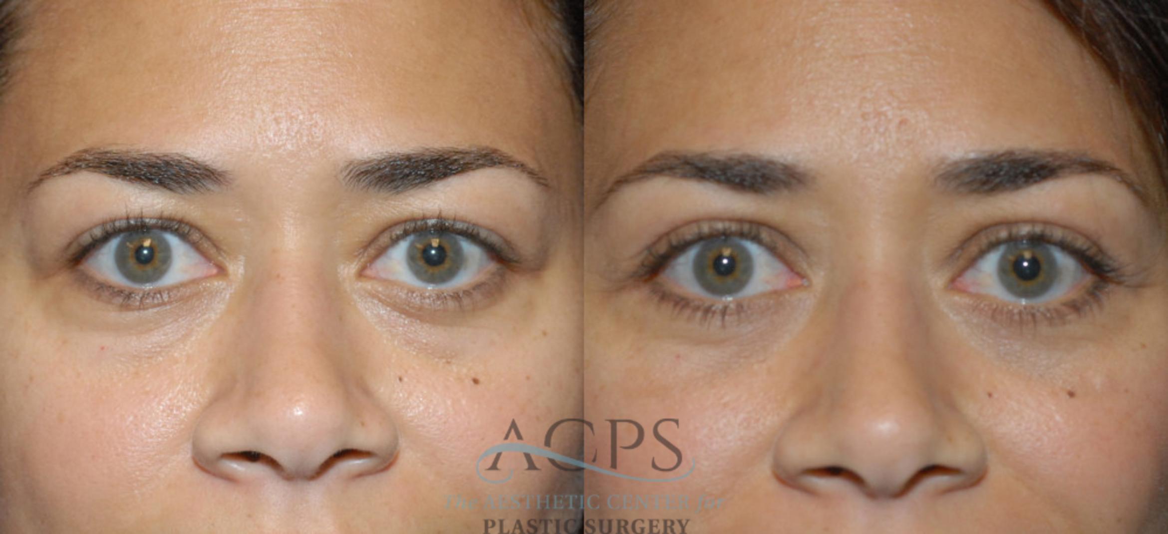 Before & After Eyelid Surgery Case 1295 Front View: View in Houston, TX