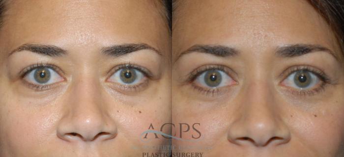 Before & After Eyelid Surgery Case 1295 Front View: View in Houston, TX