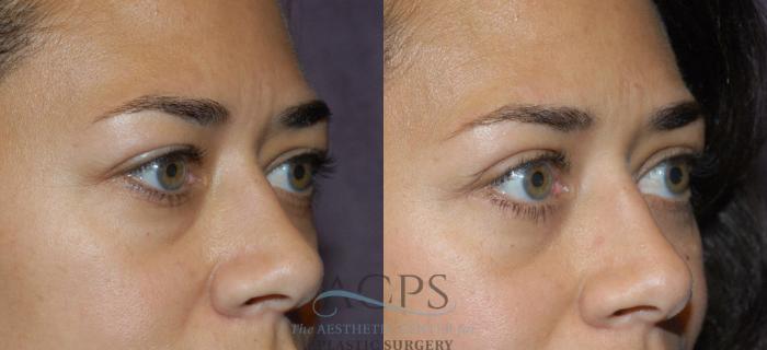 Before & After Eyelid Surgery Case 1295 Oblique View: View in Houston, TX
