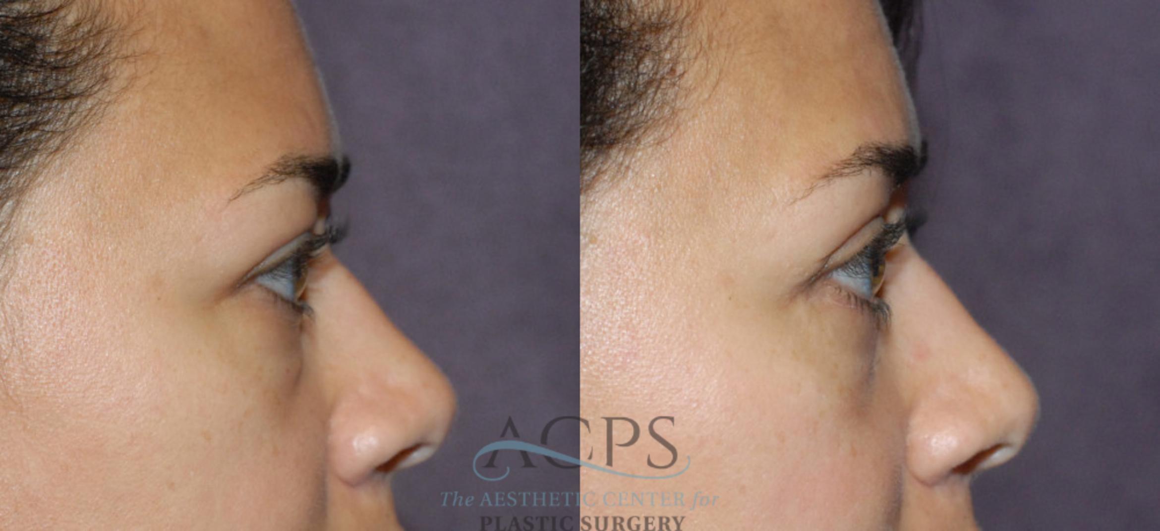 Before & After Eyelid Surgery Case 1295 Side View: View in Houston, TX