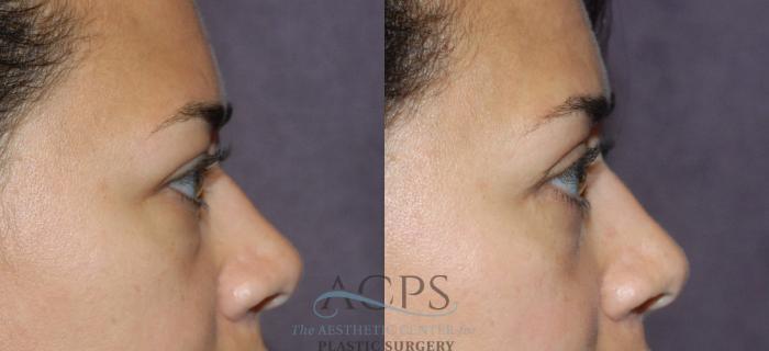 Before & After Eyelid Surgery Case 1295 Side View: View in Houston, TX