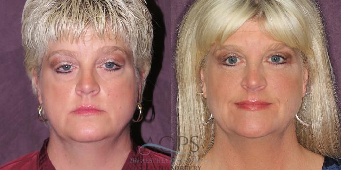 Before & After Eyelid Surgery Case 1298 Front View: View in Houston, TX