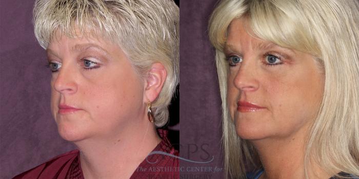 Before & After Eyelid Surgery Case 1298 Oblique Left View: View in Houston, TX