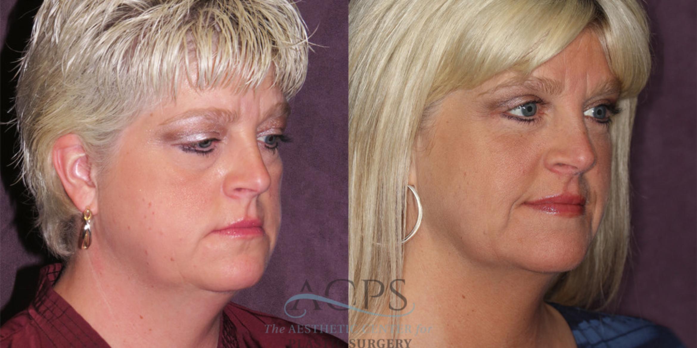 Before & After Eyelid Surgery Case 1298 Oblique Right View: View in Houston, TX