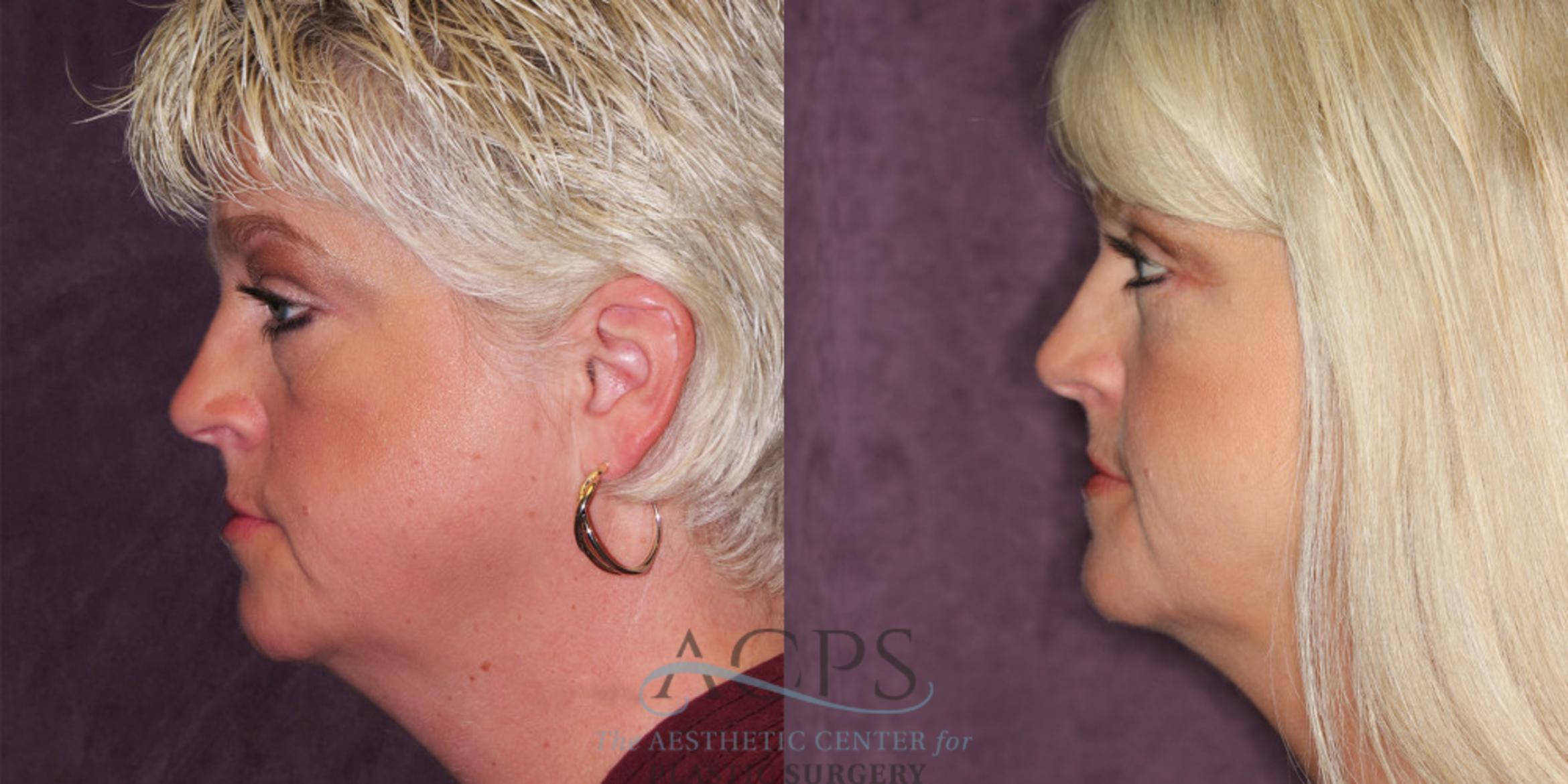 Before & After Eyelid Surgery Case 1298 Side Left View: View in Houston, TX