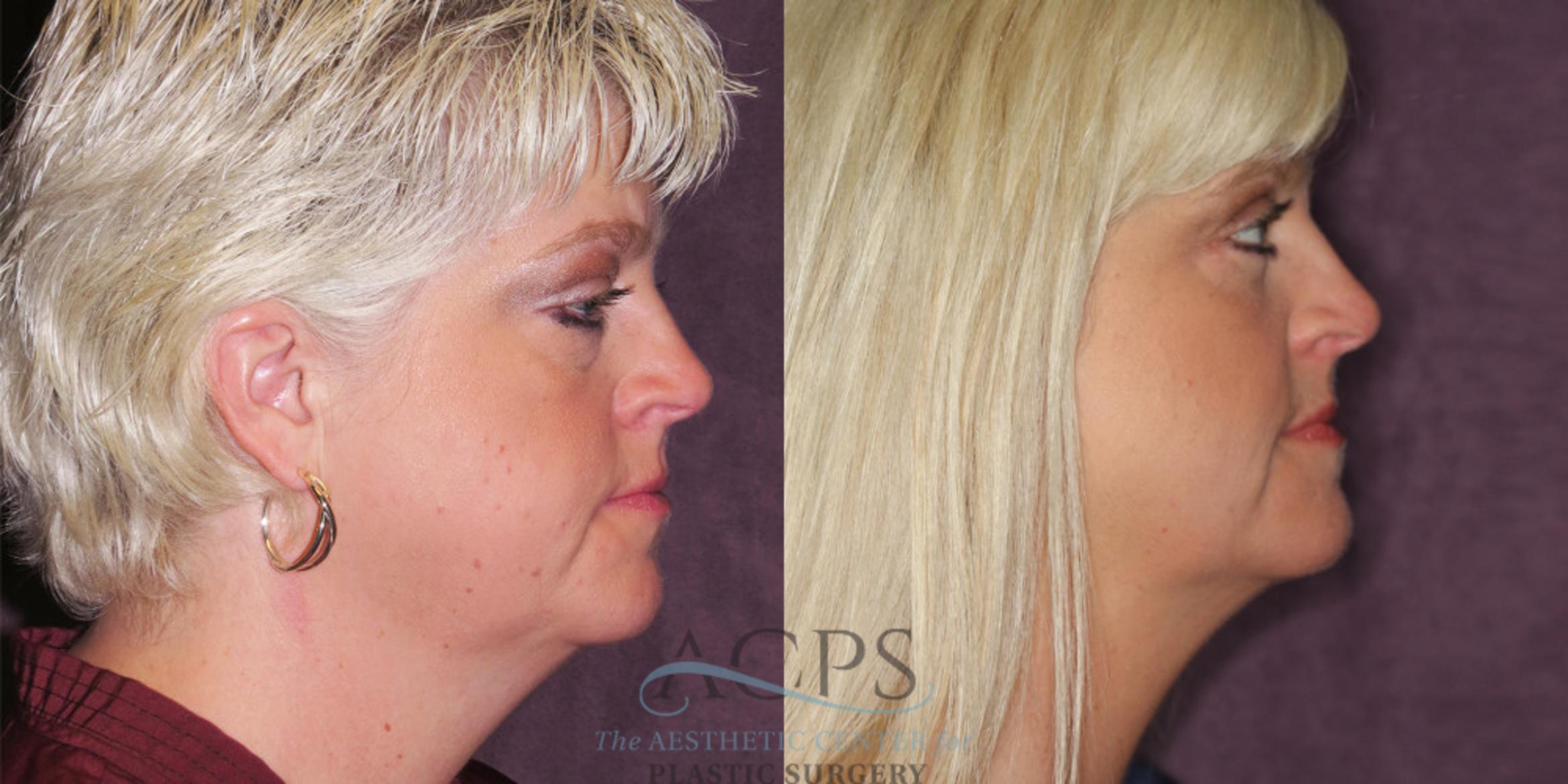 Before & After Eyelid Surgery Case 1298 Side Right View: View in Houston, TX