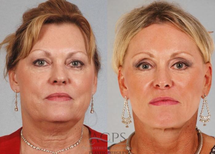 Before & After Eyelid Surgery Case 1299 Front View: View in Houston, TX