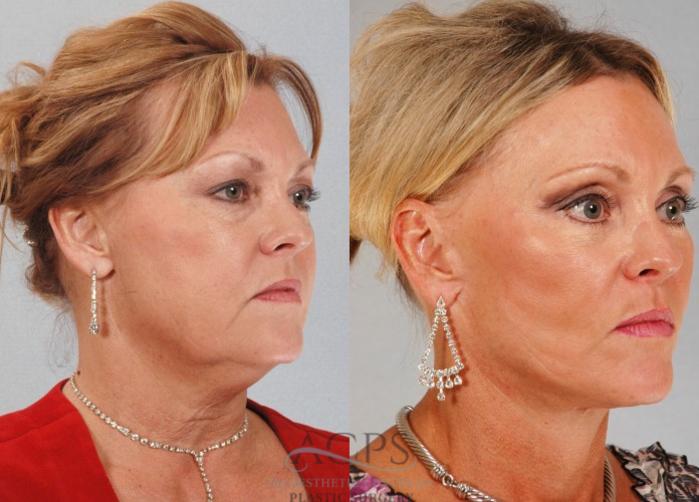 Before & After Eyelid Surgery Case 1299 Oblique View: View in Houston, TX