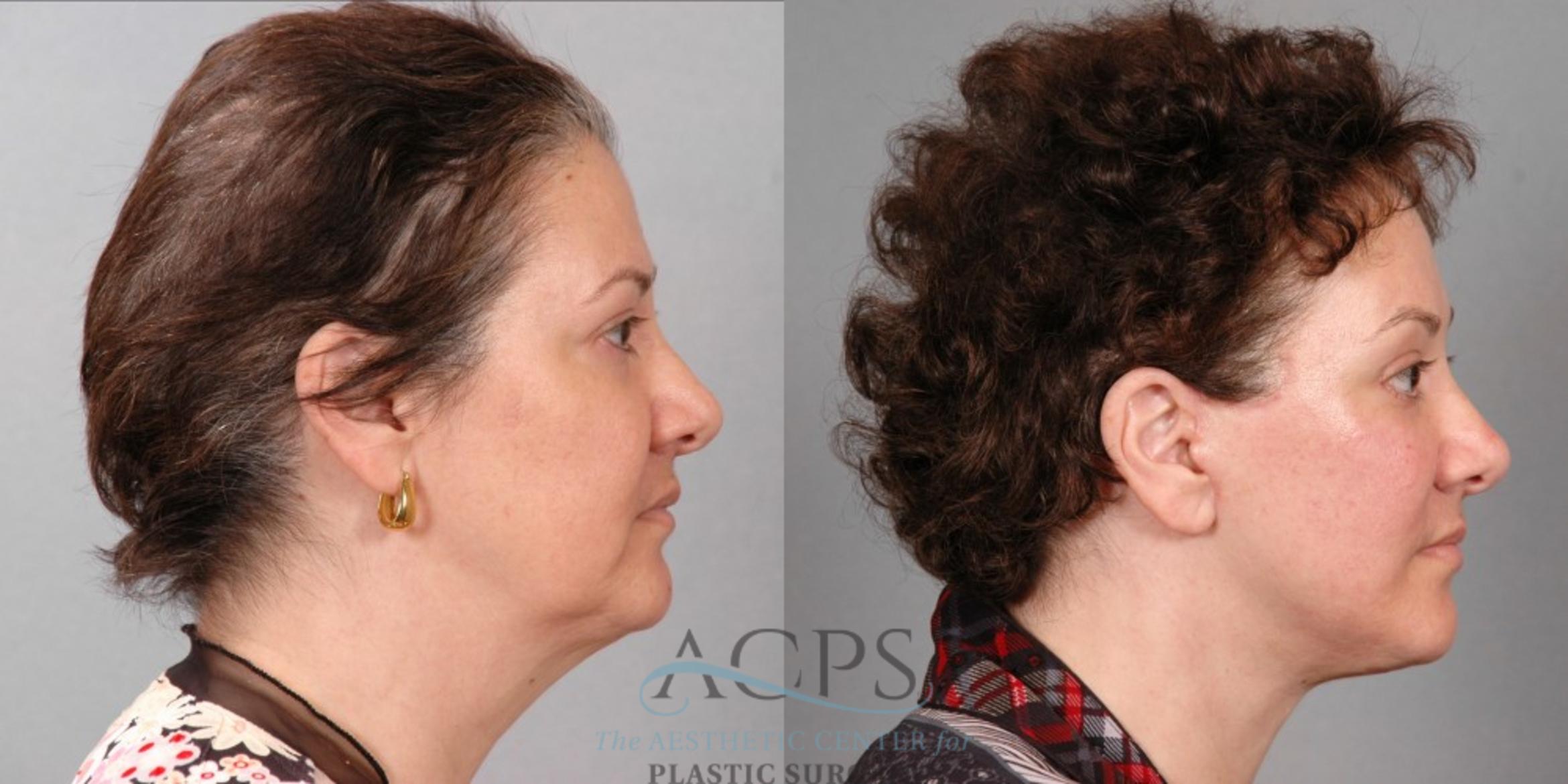 Before & After Eyelid Surgery Case 1300 Side View: View in Houston, TX