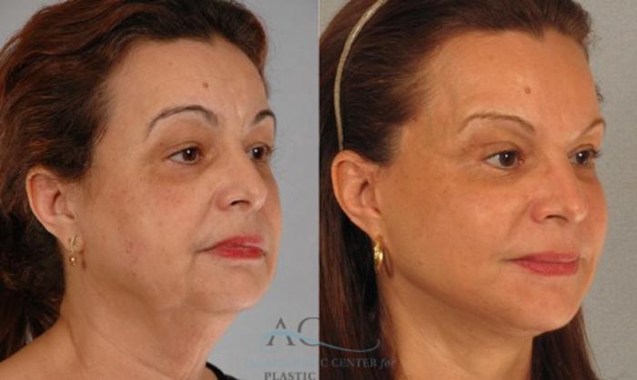 Before & After Eyelid Surgery Case 1301 Oblique View: View in Houston, TX