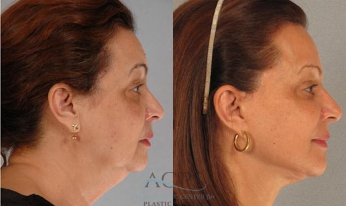 Before & After Eyelid Surgery Case 1301 Side View: View in Houston, TX