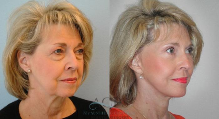Before & After Eyelid Surgery Case 1302 Oblique View: View in Houston, TX