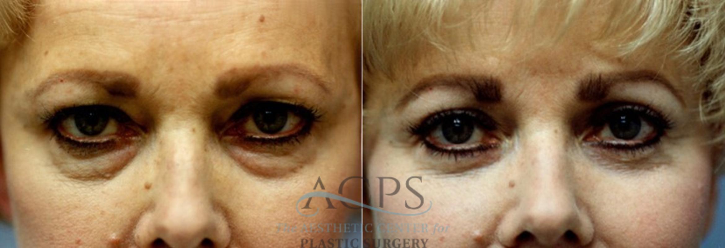 Before & After Eyelid Surgery Case 1303 Front View: View in Houston, TX