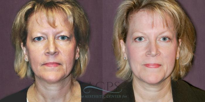 Before & After Eyelid Surgery Case 1309 Front View: View in Houston, TX