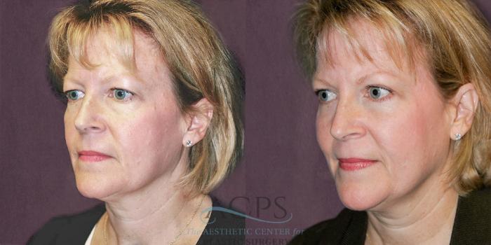 Before & After Eyelid Surgery Case 1309 Oblique Left View: View in Houston, TX