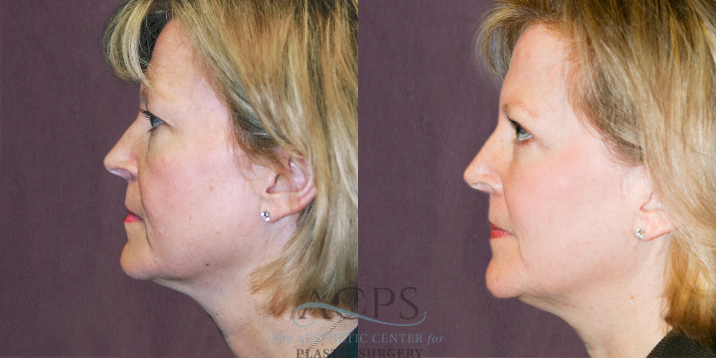 Before & After Eyelid Surgery Case 1309 Side Left View: View in Houston, TX