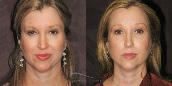Before & After Restylane Case 1311 Front View: View in Houston, TX