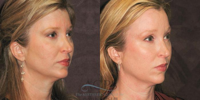 Before & After Eyelid Surgery Case 1311 Oblique Right View: View in Houston, TX