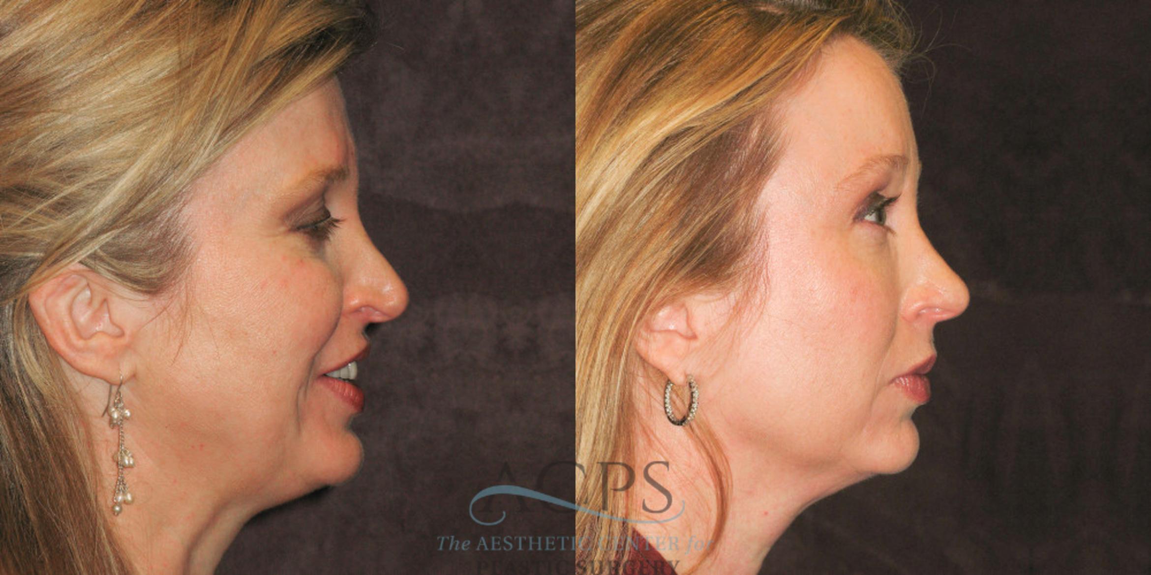 Before & After Eyelid Surgery Case 1311 Side Right View: View in Houston, TX