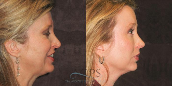 Before & After Eyelid Surgery Case 1311 Side Right View: View in Houston, TX