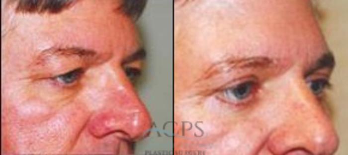 Before & After Eyelid Surgery Case 1312 Oblique View: View in Houston, TX