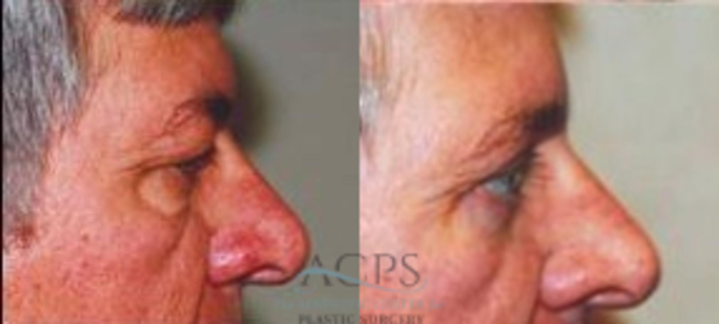 Before & After Eyelid Surgery Case 1312 Side View: View in Houston, TX
