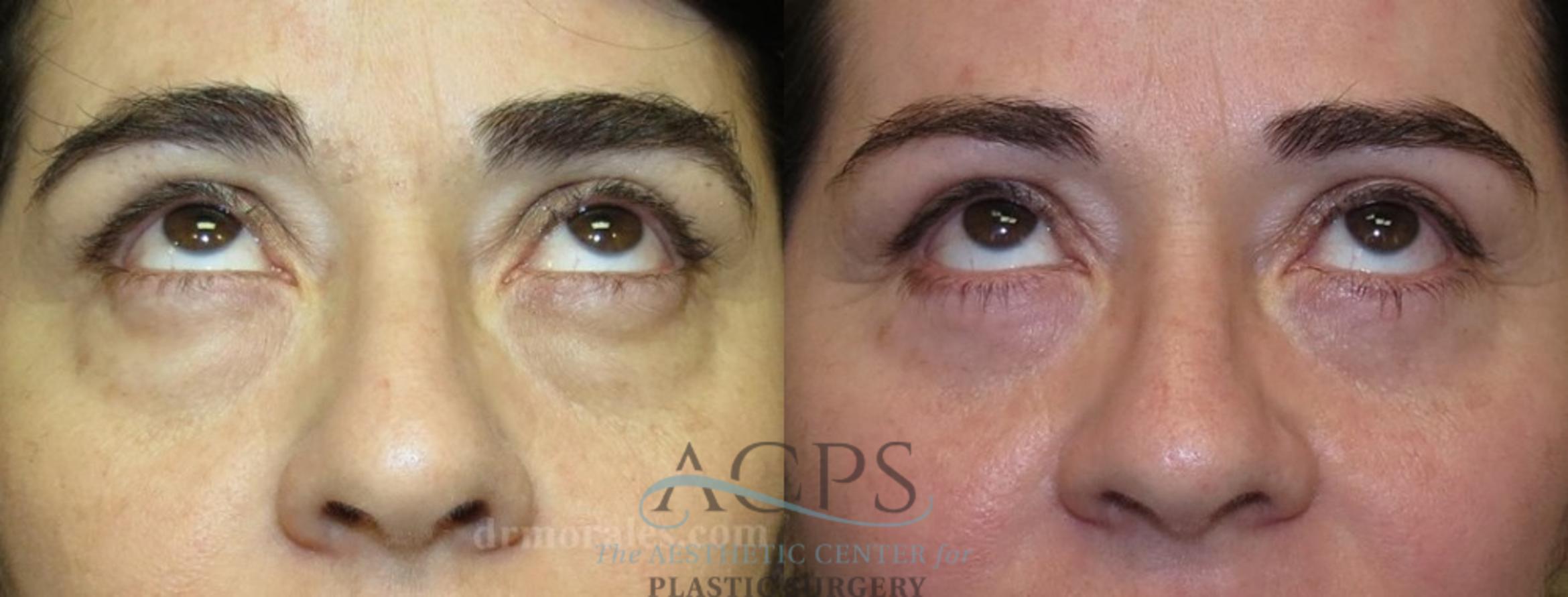 Before & After Eyelid Surgery Case 1313 Front View: View in Houston, TX