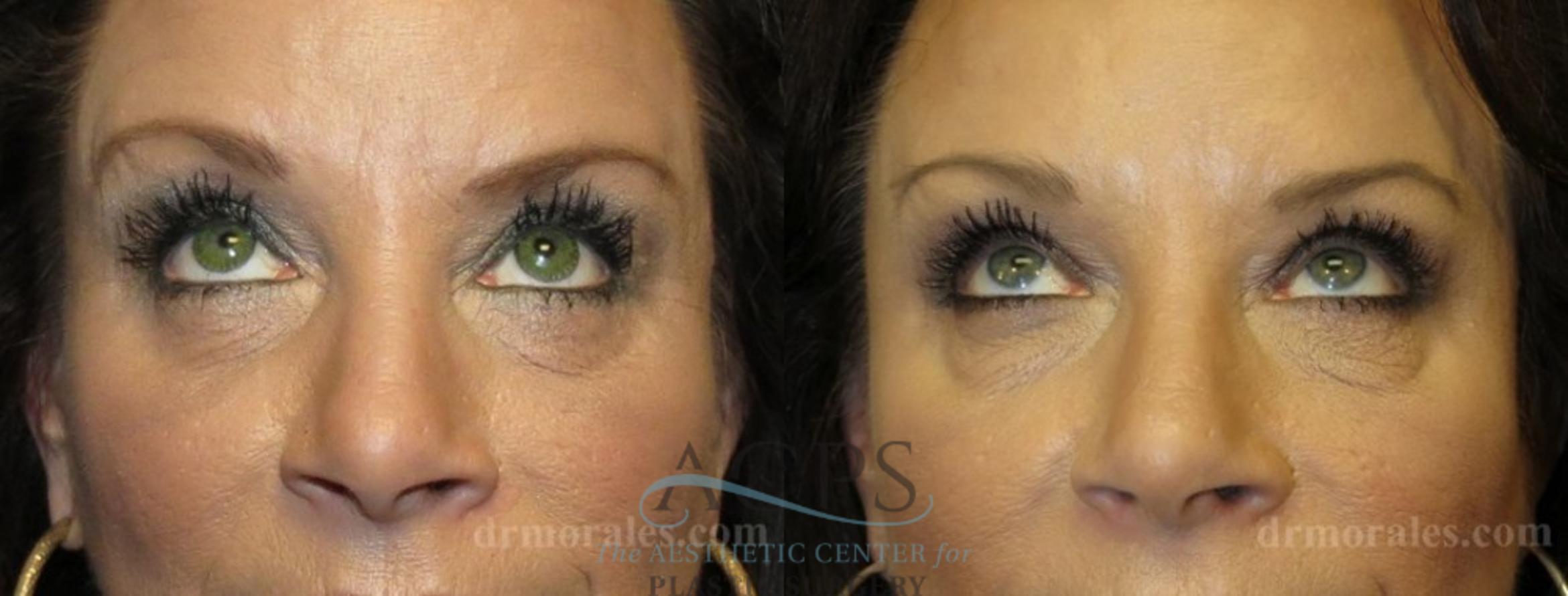 Before & After Eyelid Surgery Case 1314 Front - Eyes Open View: View in Houston, TX