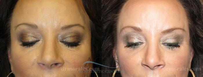 Before & After Eyelid Surgery Case 1314 Front View: View in Houston, TX