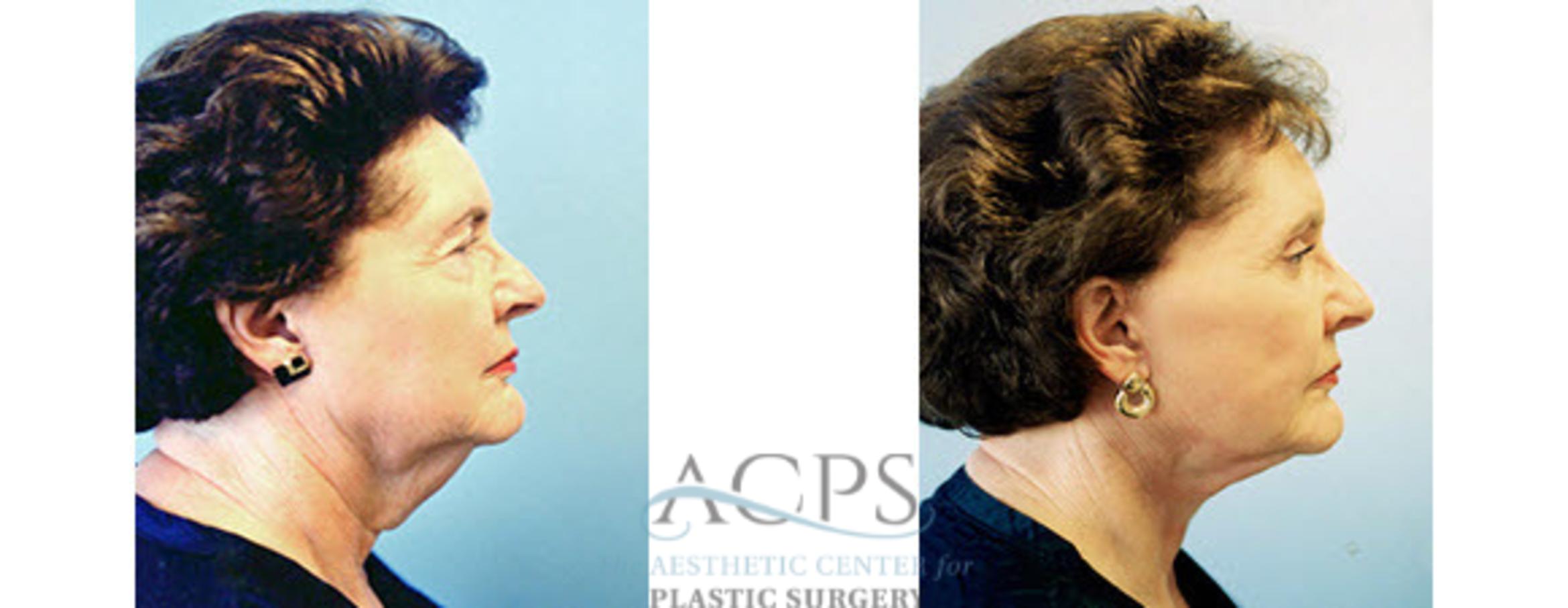 Before & After Eyelid Surgery Case 1315 Side View: View in Houston, TX