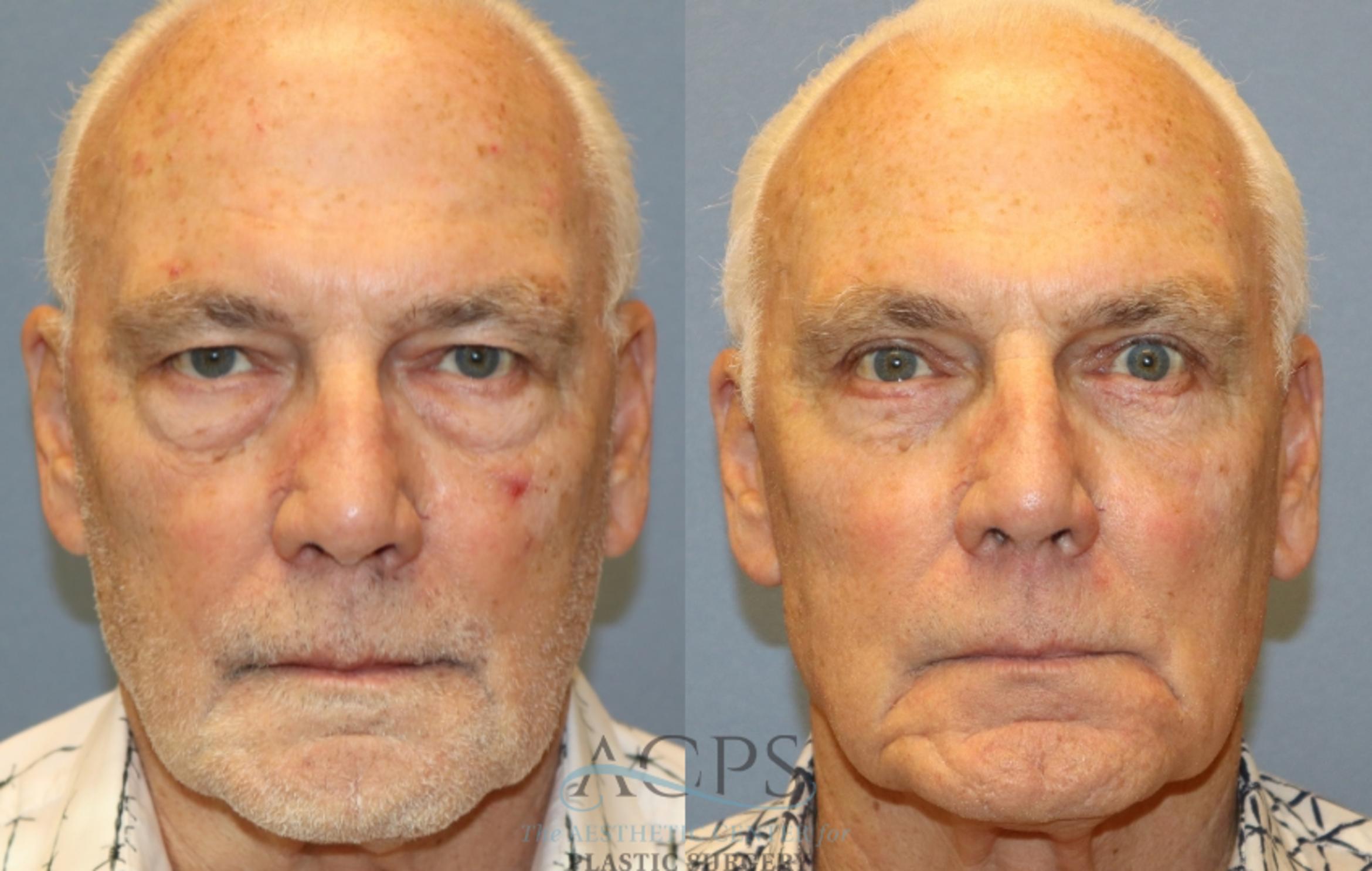 Before & After Eyelid Surgery Case 1438 Front View in Houston, TX