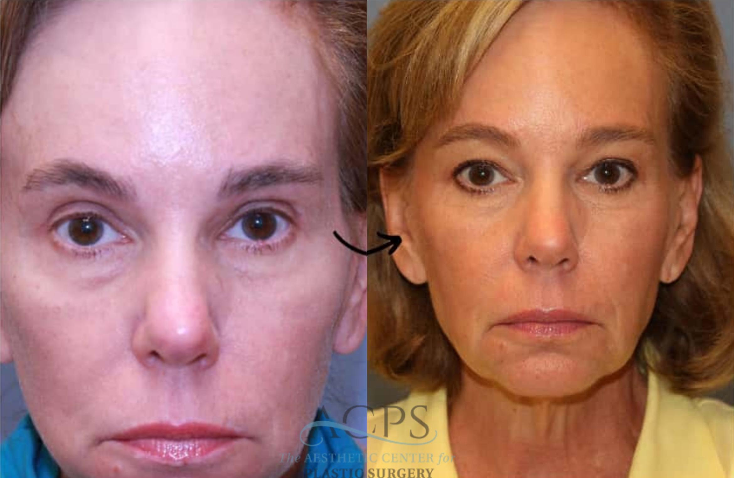 Before & After Eyelid Surgery Case 1439 Front View in Houston, TX