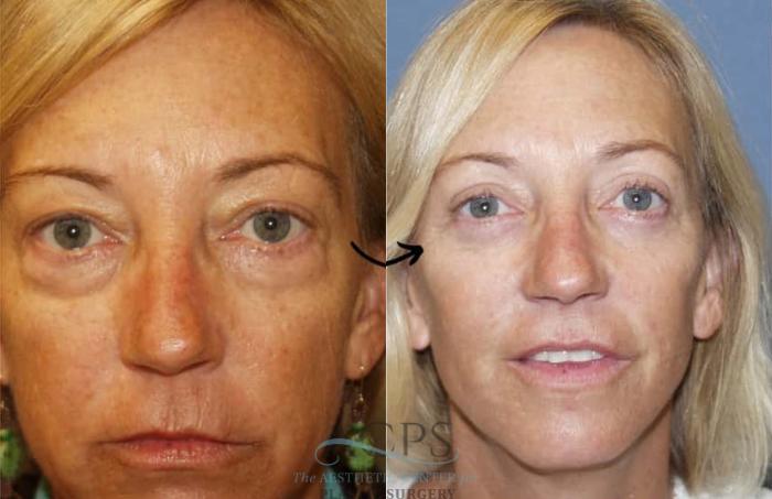 Before & After Eyelid Surgery Case 1440 Front View in Houston, TX