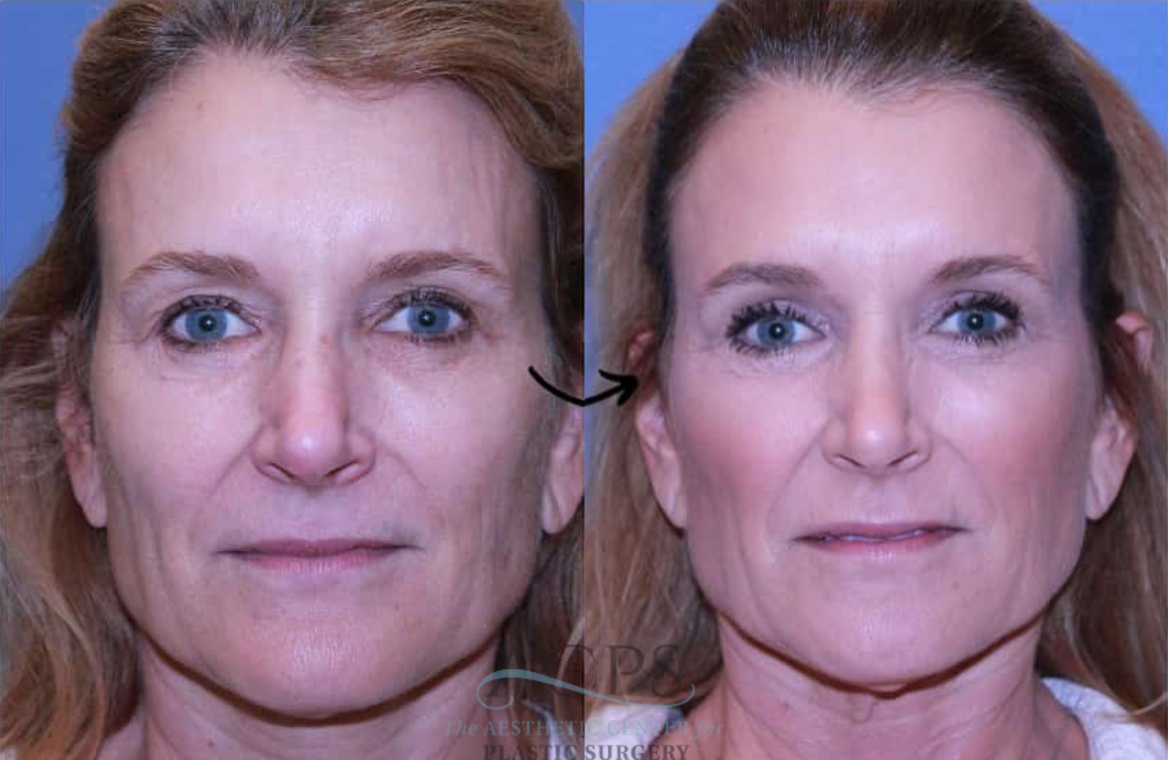 Before & After Eyelid Surgery Case 1441 Front View in Houston, TX