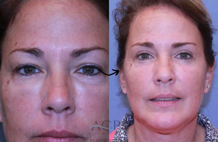 Before & After Eyelid Surgery Case 1442 Front View in Houston, TX