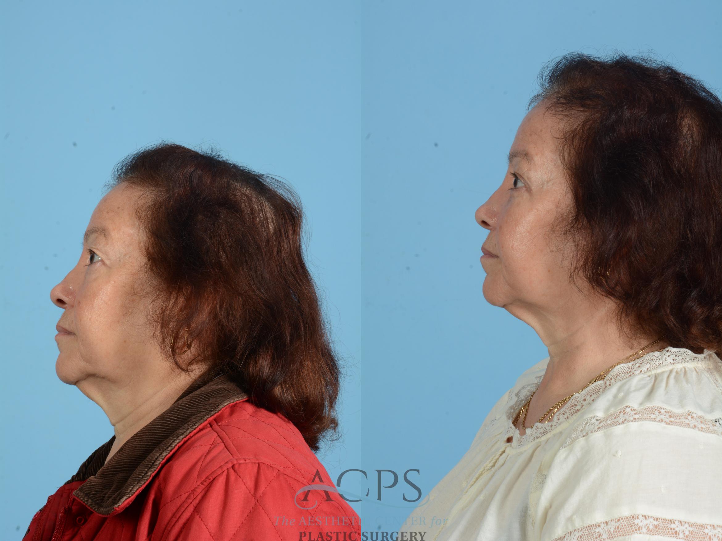 Before & After Fat Grafting Case 1554 Left Side View in Houston, TX