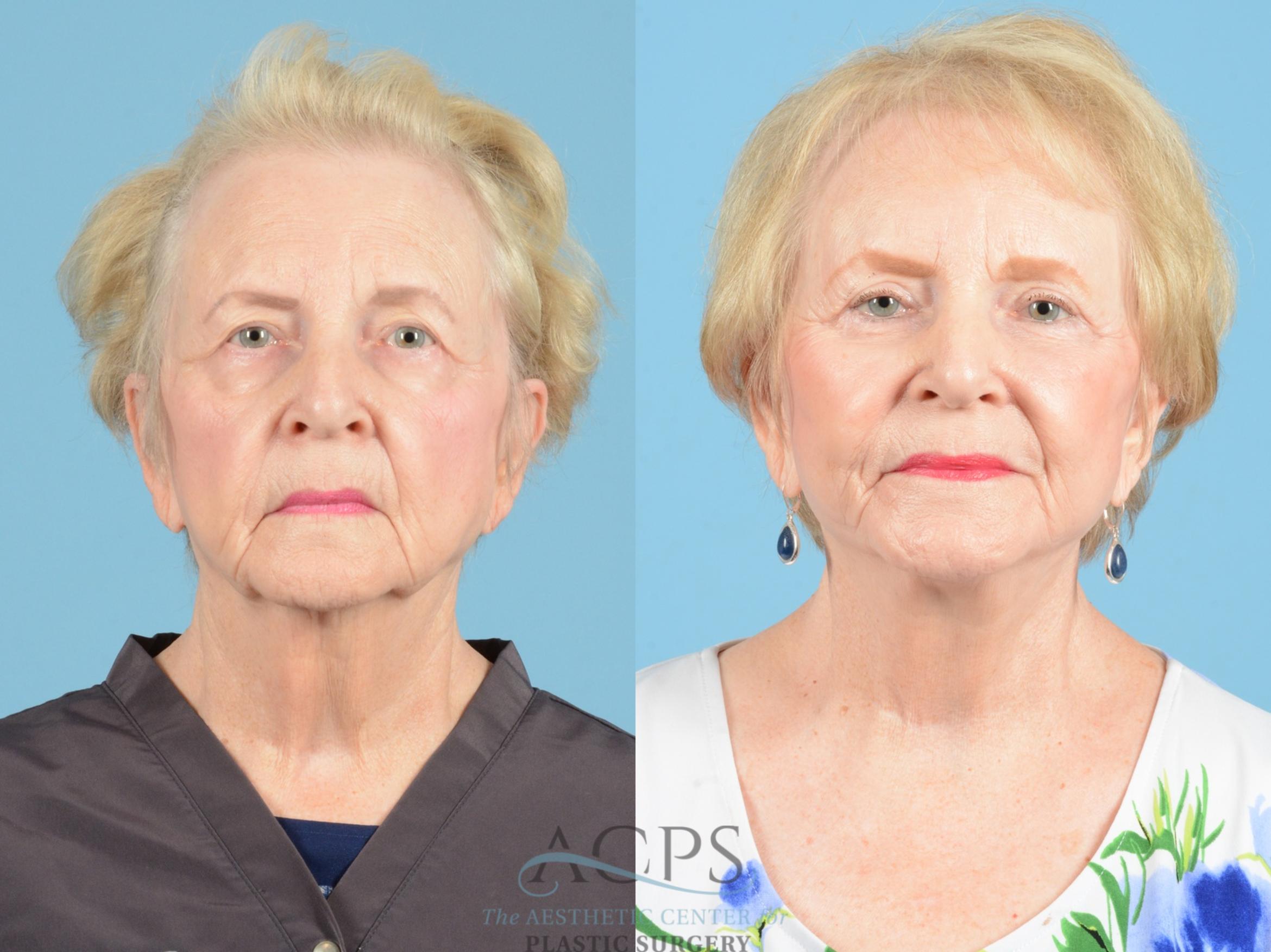 Before & After Facelift Case 1218 Front View: View in Houston, TX