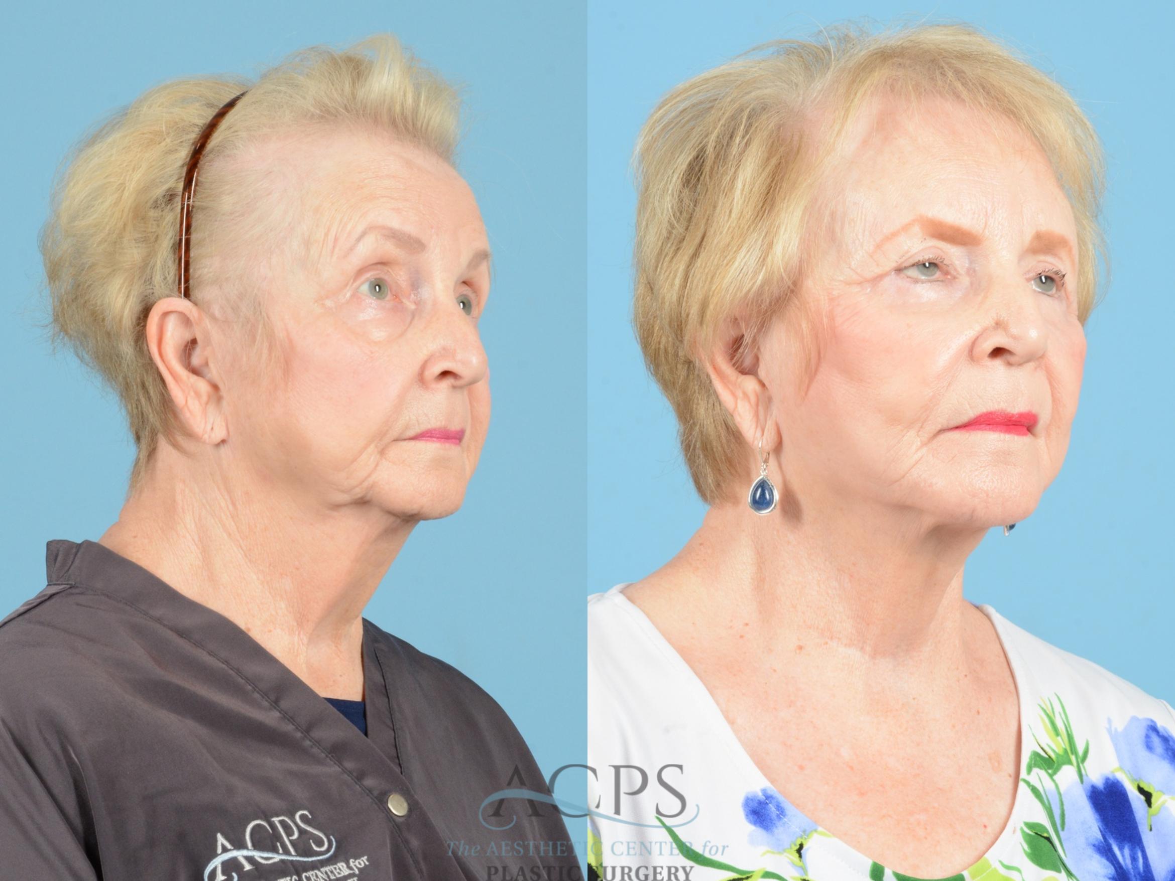 Before & After Facelift Case 1218 Oblique View: View in Houston, TX