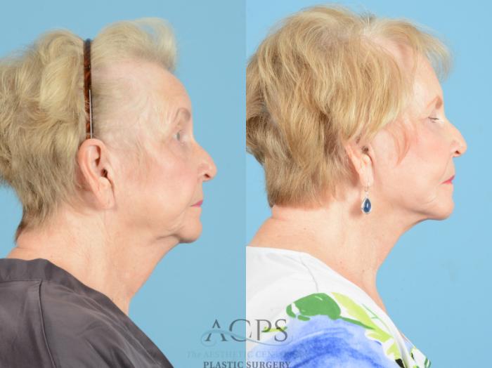 Before & After Facelift Case 1218 Side View: View in Houston, TX