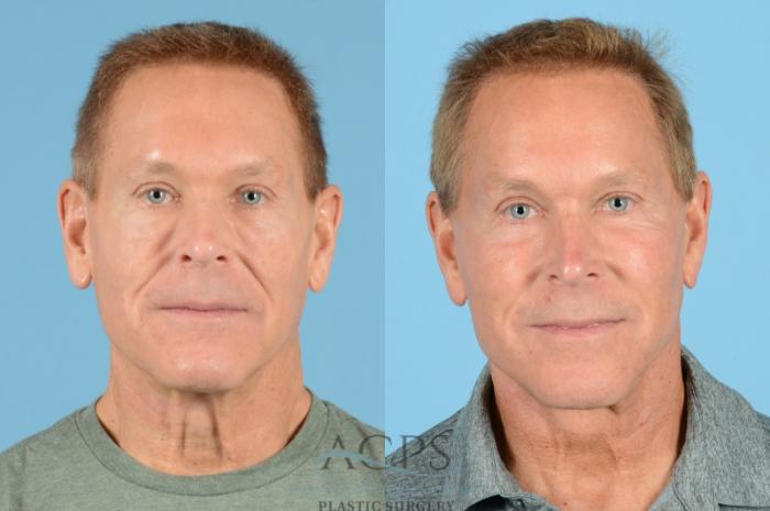 Before & After Septoplasty with Rhinoplasty Case 1219 Front View: View in Houston, TX