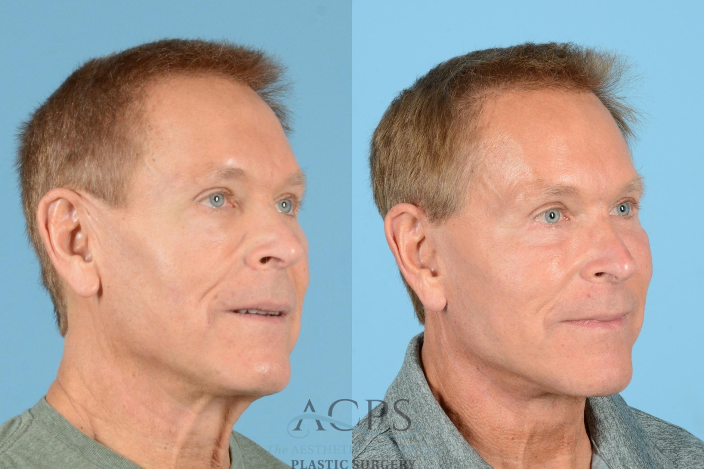 Before & After Facelift Case 1219 Oblique View: View in Houston, TX