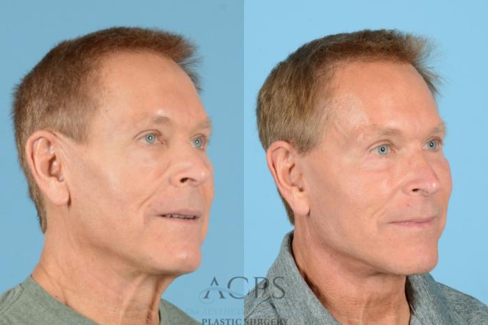 Before & After Facelift Case 1219 Oblique View: View in Houston, TX