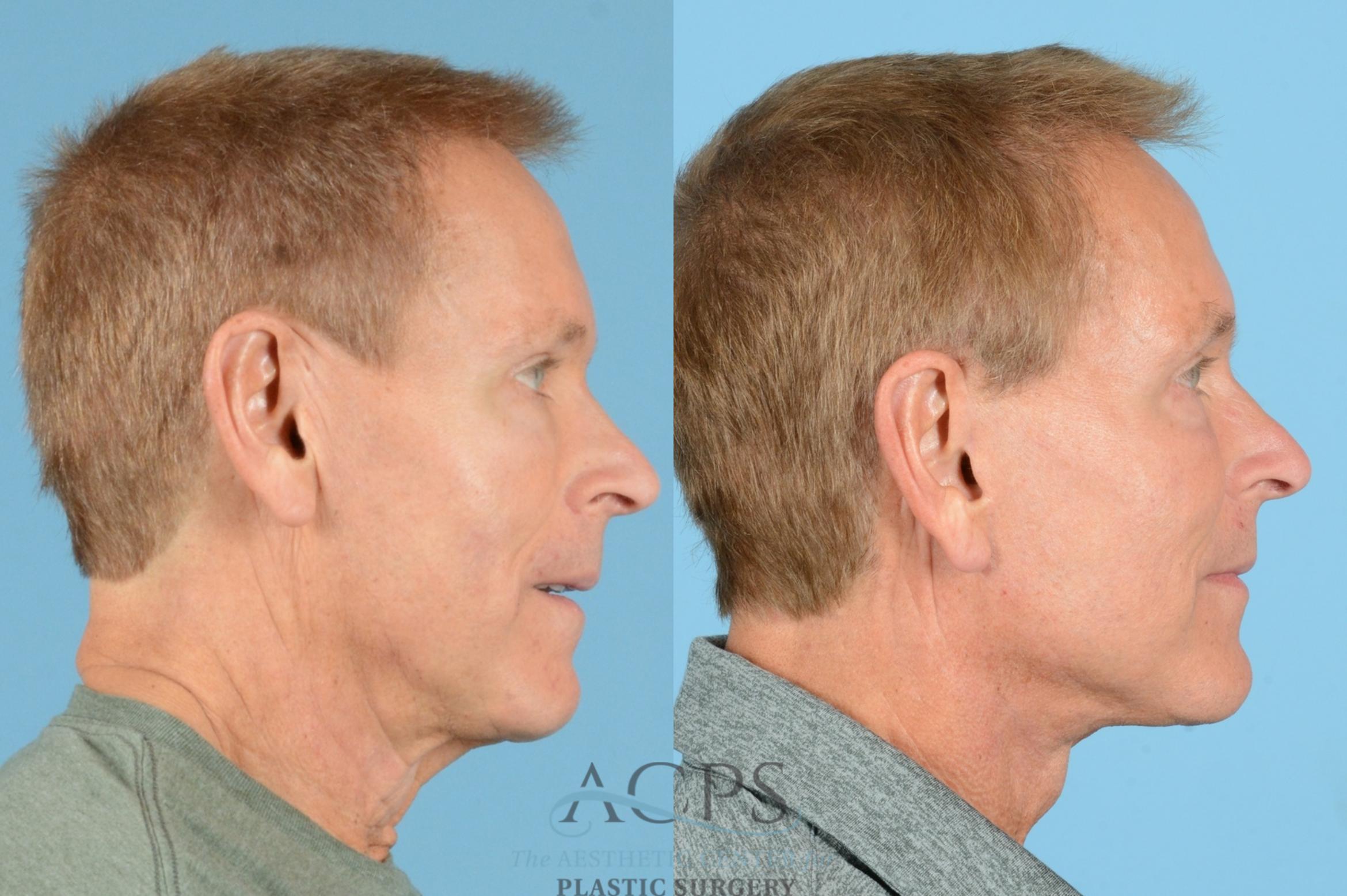 Before & After Facelift Case 1219 Side View: View in Houston, TX