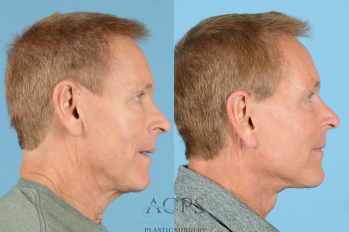 Before & After Facelift Case 1219 Side View: View in Houston, TX