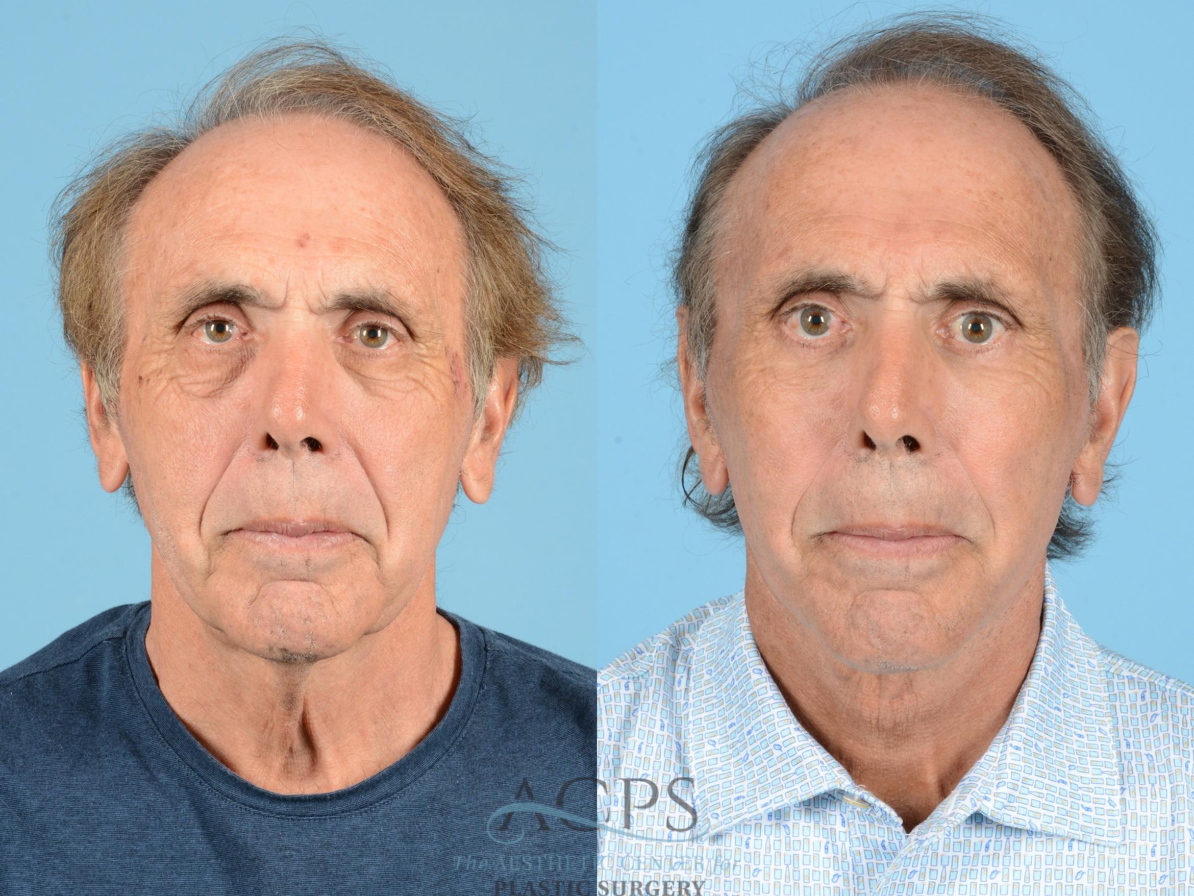 Before & After Facelift Case 1220 Front View: View in Houston, TX
