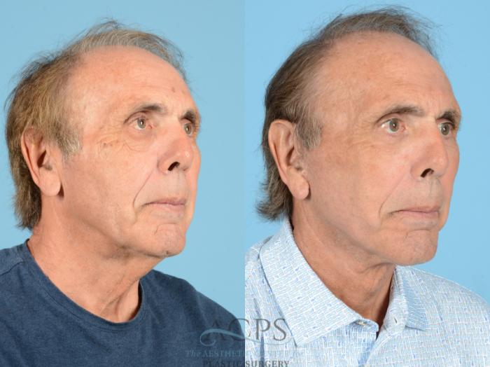 Before & After Facelift Case 1220 Oblique View: View in Houston, TX