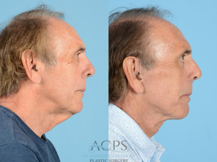 Before & After Facelift Case 1220 Side View: View in Houston, TX