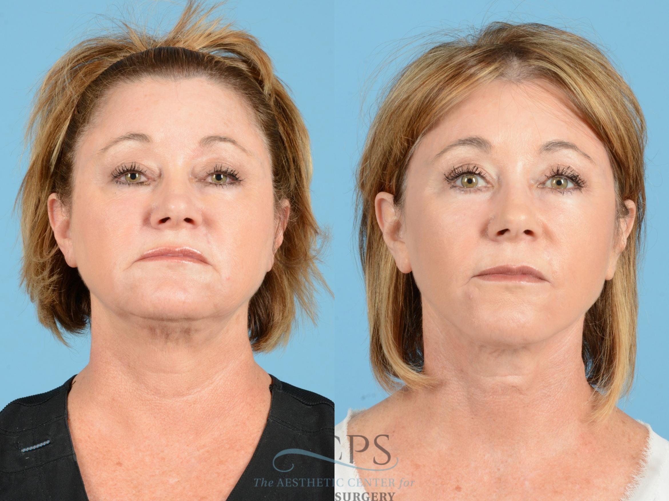 Before & After Facelift Case 1221 Front View: View in Houston, TX