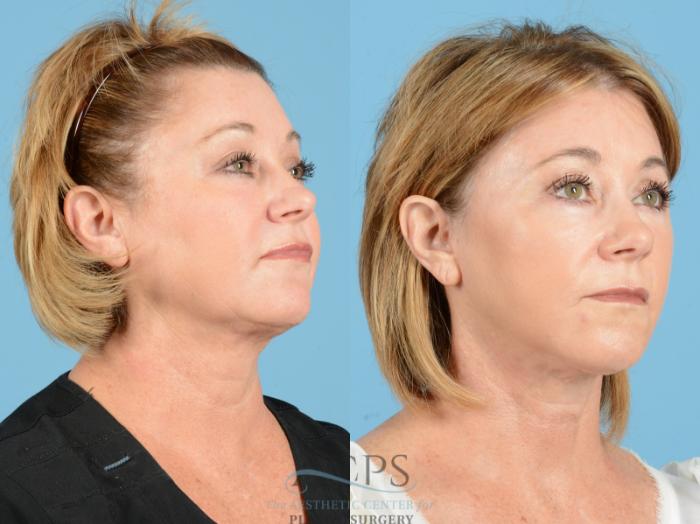 Before & After Facelift Case 1221 Oblique View: View in Houston, TX