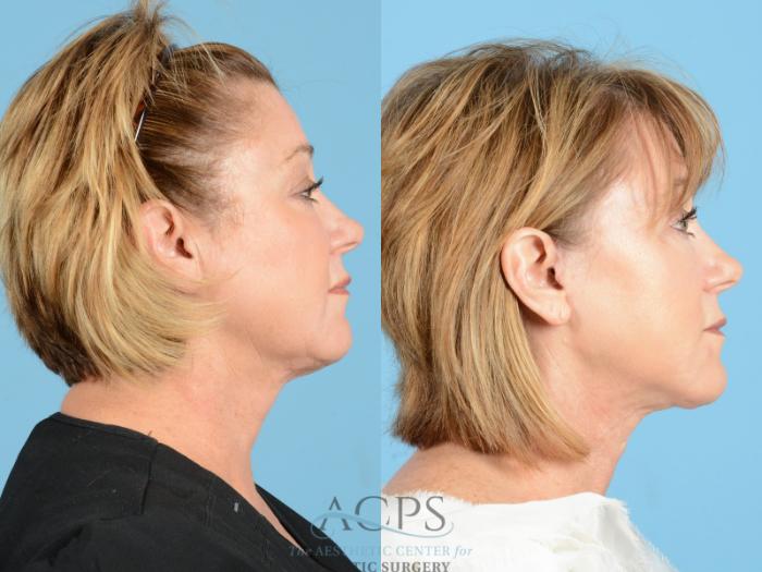 Before & After Facelift Case 1221 Side View: View in Houston, TX